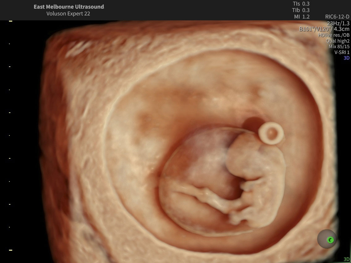 Ultrasound Scans – East Melbourne Ultrasound